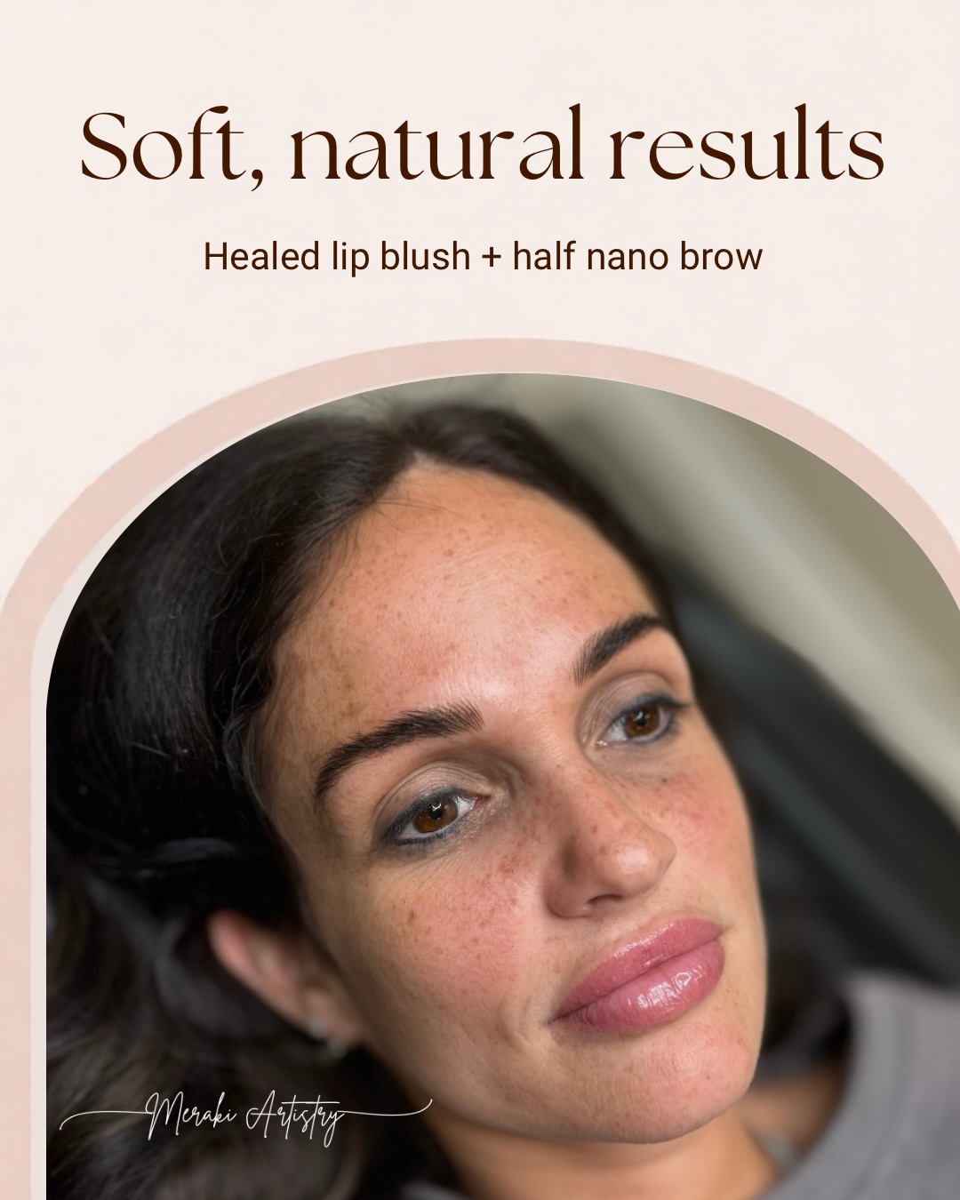 Why old microblading needed to go — faded, patchy, and just not it anymore. We got her set up with laser tattoo removal to safely fade the old work before starting fresh.
AFTER: A soft, natural lip blush for that your-lips-but-better pink tint, plus a half brow — filling in just the front of the brow to add density and shape without looking overdone. The result? Effortless, natural beauty that lasts.
What’s a half brow? 👉 Instead of a full nano brow, we focus pigment on the front portion of the brow where hair is often sparsest — adding fullness and a defined shape while keeping the tail soft and natural.
Old permanent makeup doesn’t have to be permanent. 💫 Whether you’re ready to remove old work or start something new, we’ve got you.
📍 FREE CONSULTATIONS available for:
• Laser tattoo removal
• Permanent makeup
• Nano brows
• Lip blush
Book yours today — link in bio!
#BeforeAndAfter #LipBlush #NanoBrows #HalfBrow #LaserTattooRemoval
PMU PermanentMakeup BrowTransformation NaturalBeauty