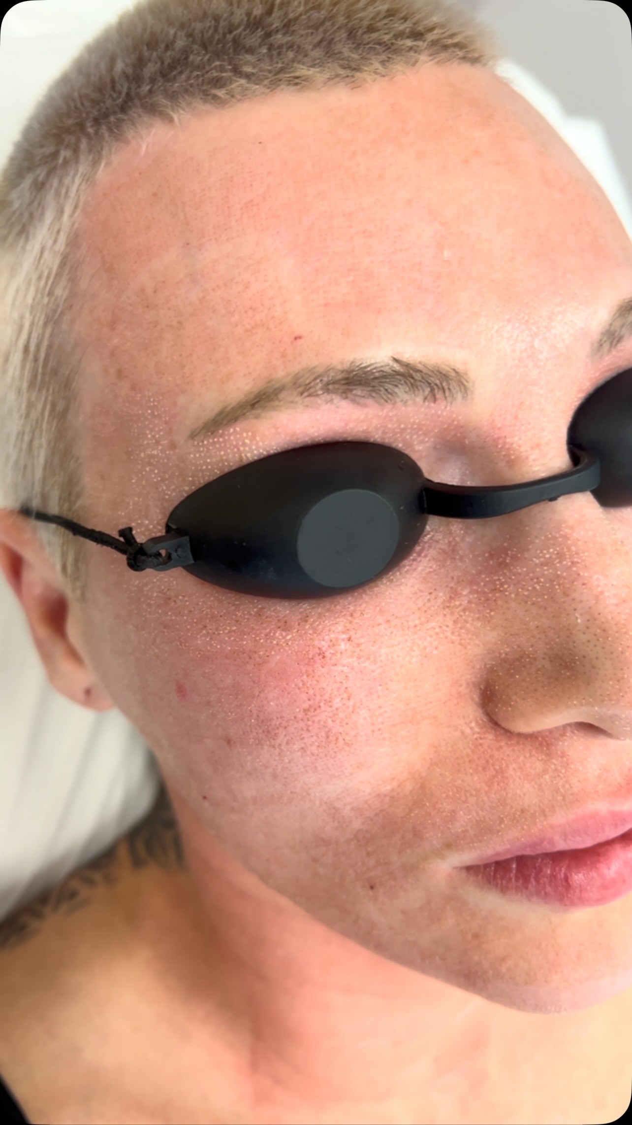 Oshhhh CO2 crispness!
It’s officially CO2 season, book your free patch test today and get ready for airbrushed Skin!
So what does it do?
CO2 fractional laser — when skincare alone isn’t enough.
Designed to stimulate collagen and resurface the skin, helping to improve:
• Fine lines & wrinkles
• Skin texture and enlarged pores
• Acne scarring
• Pigmentation and sun damage
• Crepey skin, particularly around the eyes
• Overall skin quality and firmness
One of my favourite treatments for creating real, progressive change in the skin.
Every treatment is tailored to your skin, your concerns and the level of downtime that suits you.
Complimentary consultations available.
R x